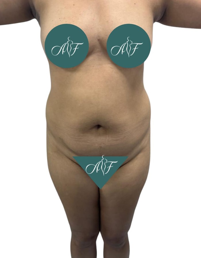 Antes — Abdominoplastia + Lipo 360