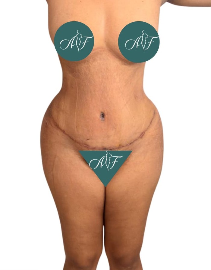 Después — Abdominoplastia + Lipo 360