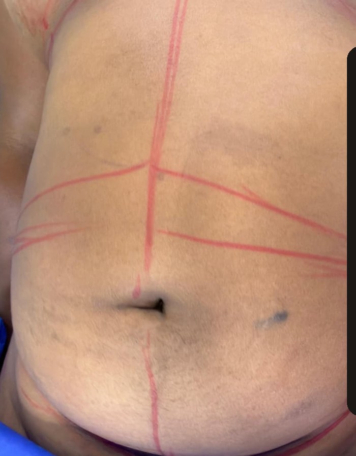 Antes — Lipoescultura · Abdomen