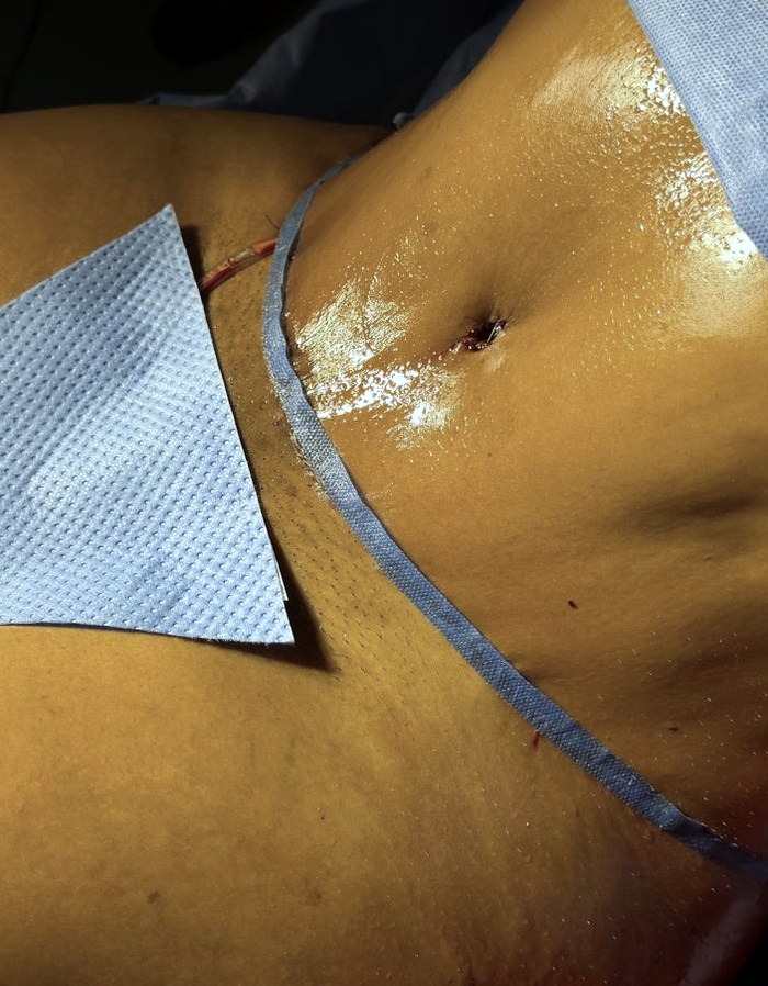 Después — Lipoescultura · Abdomen