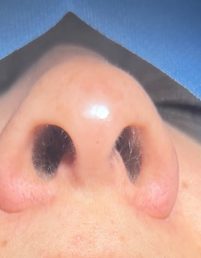 Antes — Rinoplastia