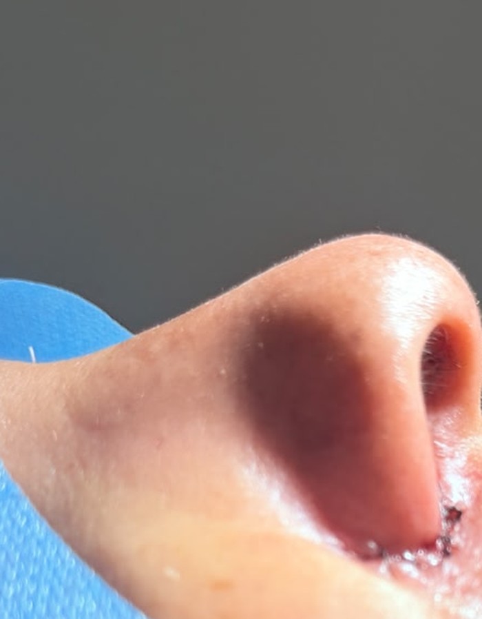 Después — Rinoplastia